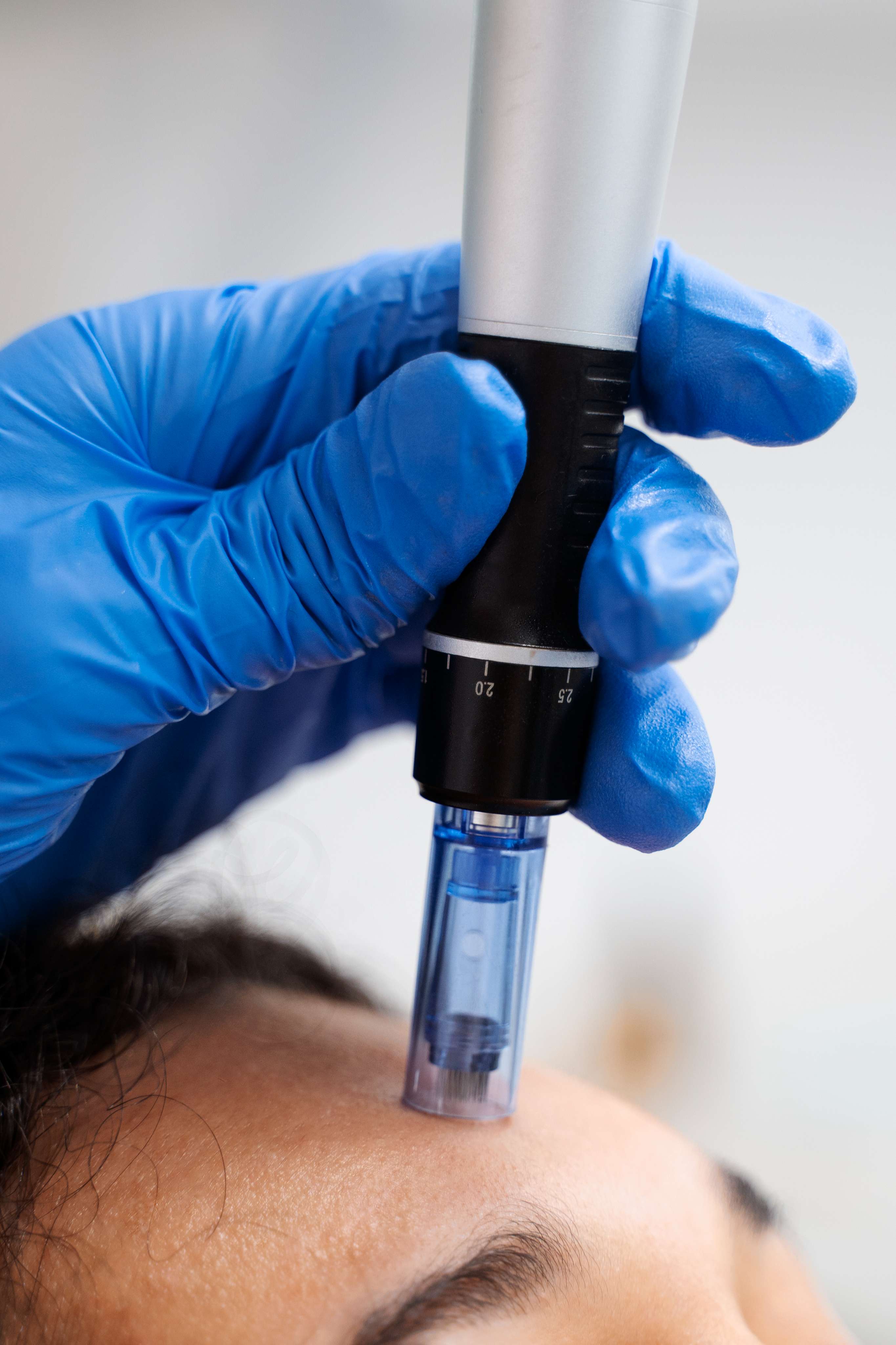 RF Microneedling